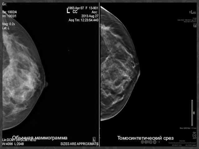Томосинтетический срез Обычная маммограмма