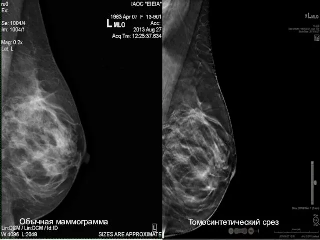 Томосинтетический срез Обычная маммограмма