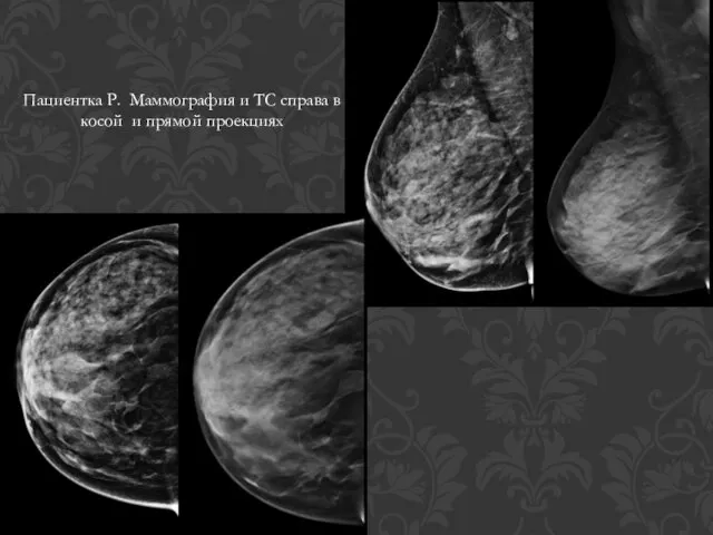 Пациентка Р. Маммография и ТС справа в косой и прямой проекциях