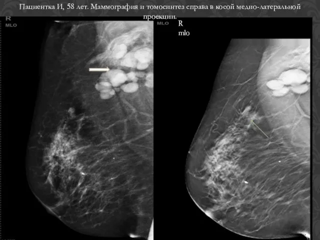 Пациентка И, 58 лет. Маммография и томосинтез справа в косой медио-латеральной проекции. R mlo
