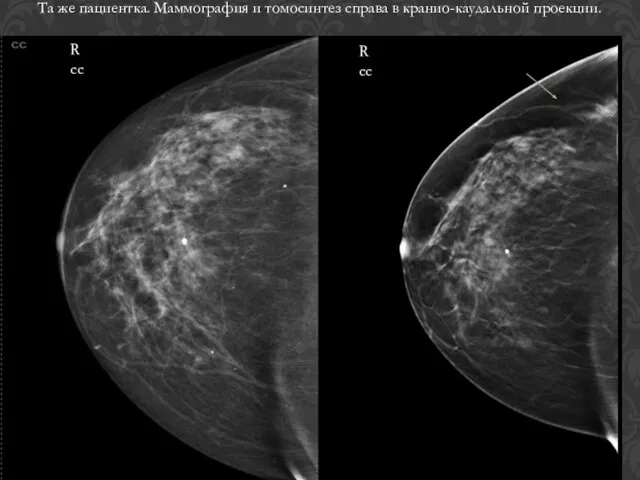 R сс R сс Та же пациентка. Маммография и томосинтез справа в кранио-каудальной проекции.