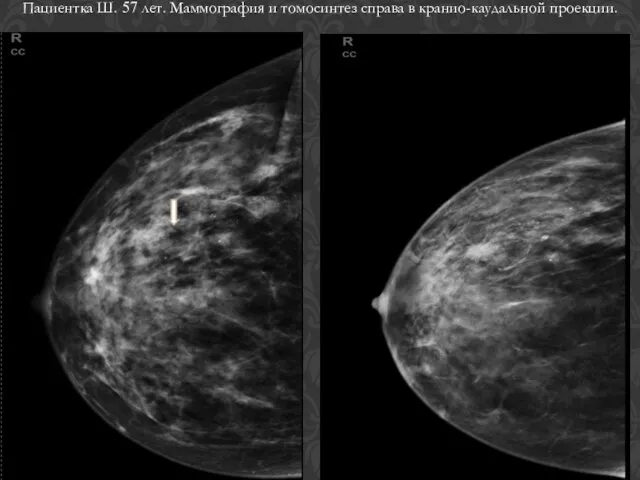 Пациентка Ш. 57 лет. Маммография и томосинтез справа в кранио-каудальной проекции.