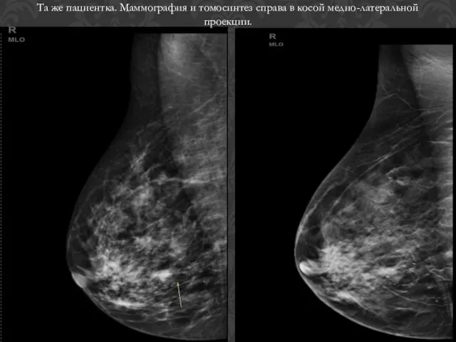 Та же пациентка. Маммография и томосинтез справа в косой медио-латеральной проекции.