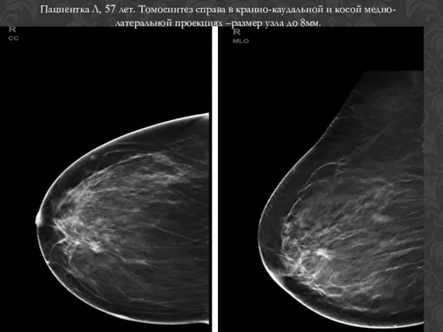 Пациентка Л, 57 лет. Томосинтез справа в кранио-каудальной и косой медио-латеральной проекциях –размер узла до 8мм.
