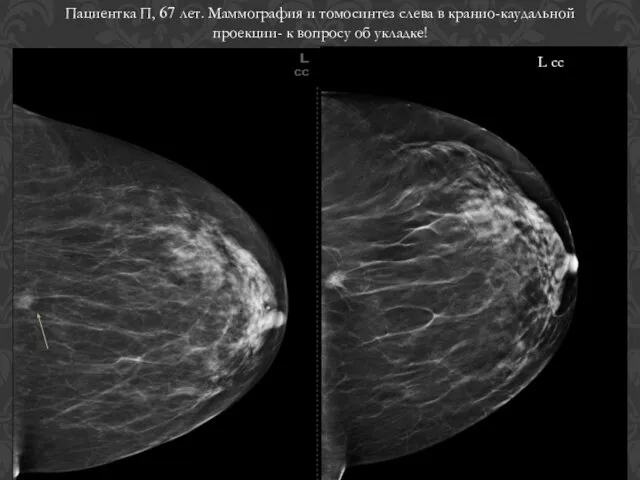 L сс Пациентка П, 67 лет. Маммография и томосинтез слева в