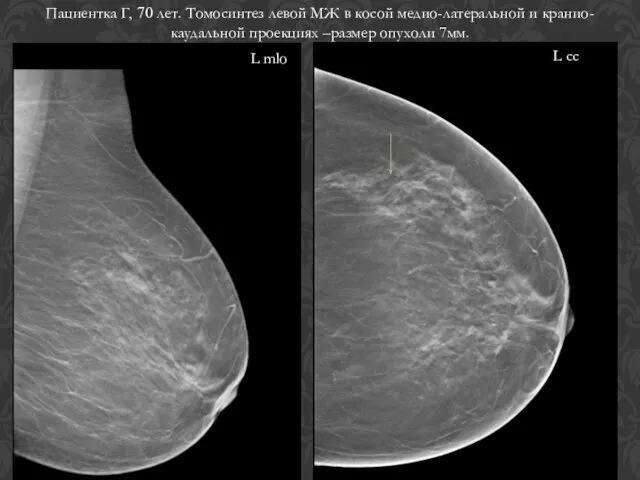 Пациентка Г, 70 лет. Томосинтез левой МЖ в косой медио-латеральной и