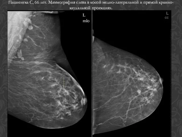 L mlo Пациентка С, 66 лет. Маммография слева в косой медио-латеральной и прямой кранио-каудальной проекциях.