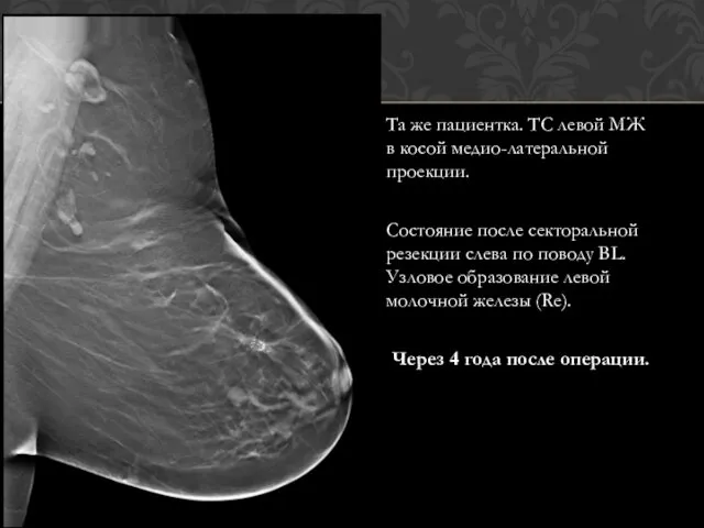 Та же пациентка. ТС левой МЖ в косой медио-латеральной проекции. Состояние