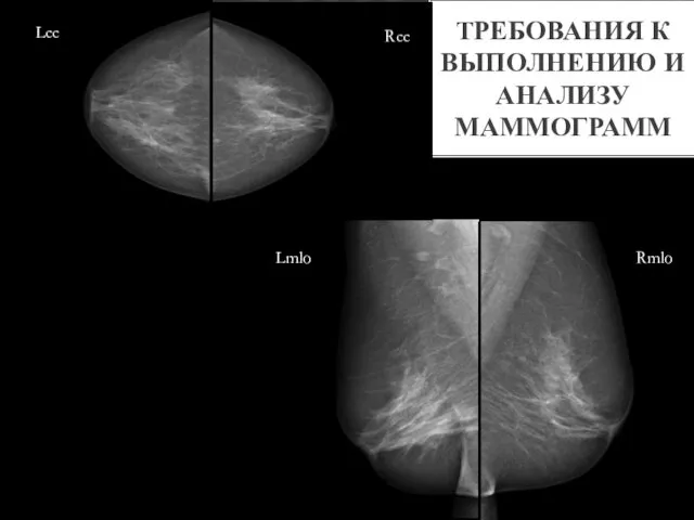 ТРЕБОВАНИЯ К ВЫПОЛНЕНИЮ И АНАЛИЗУ МАММОГРАММ Rcc Lcc Rmlo Lmlo