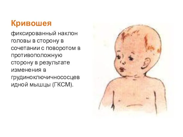 Кривошея фиксированный наклон головы в сторону в сочетании с поворотом в