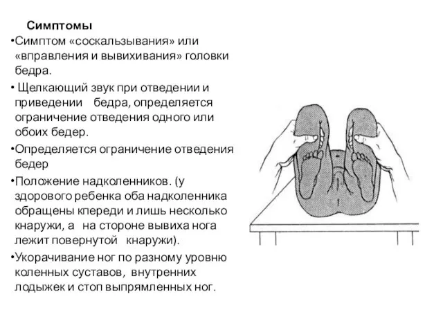 Симптомы Симптом «соскальзывания» или «вправления и вывихивания» головки бедра. Щелкающий звук