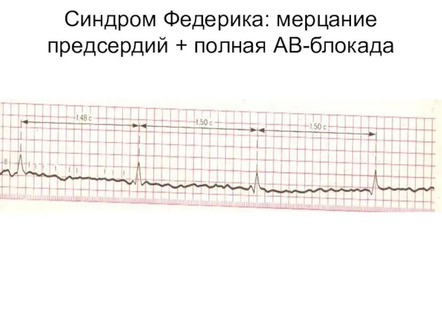 Синдром Федерика: мерцание предсердий + полная АВ-блокада