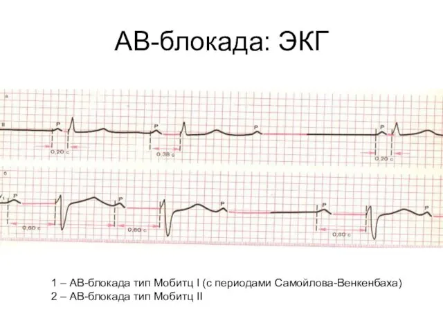 АВ-блокада: ЭКГ 1 – АВ-блокада тип Мобитц I (с периодами Самойлова-Венкенбаха)