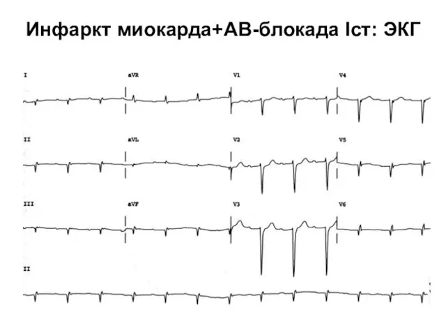 Инфаркт миокарда+АВ-блокада Iст: ЭКГ