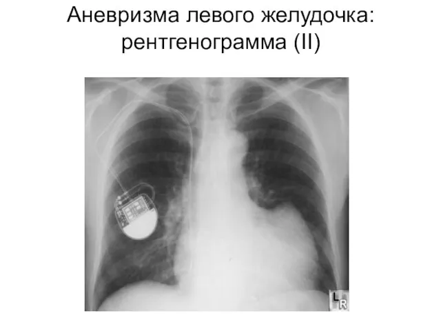 Аневризма левого желудочка: рентгенограмма (II)
