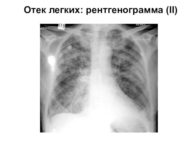 Отек легких: рентгенограмма (II)