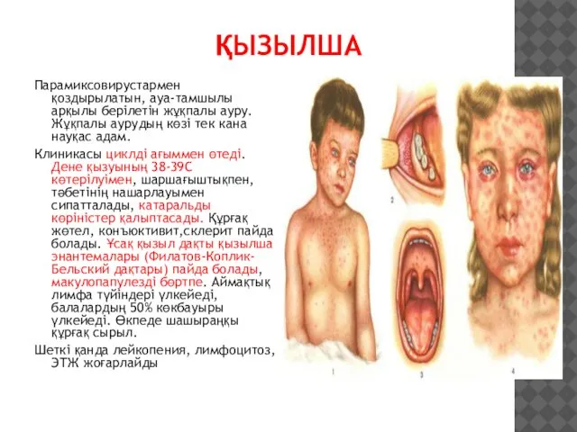 ҚЫЗЫЛША Парамиксовирустармен қоздырылатын, ауа-тамшылы арқылы берілетін жұқпалы ауру. Жұқпалы аурудың көзі