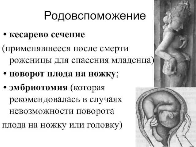 Родовспоможение кесарево сечение (применявшееся после смерти роженицы для спасения младенца) поворот