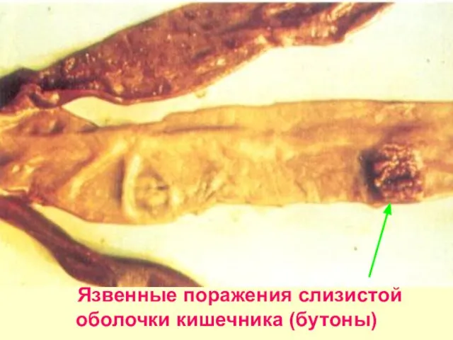 Язвенные поражения слизистой оболочки кишечника (бутоны)