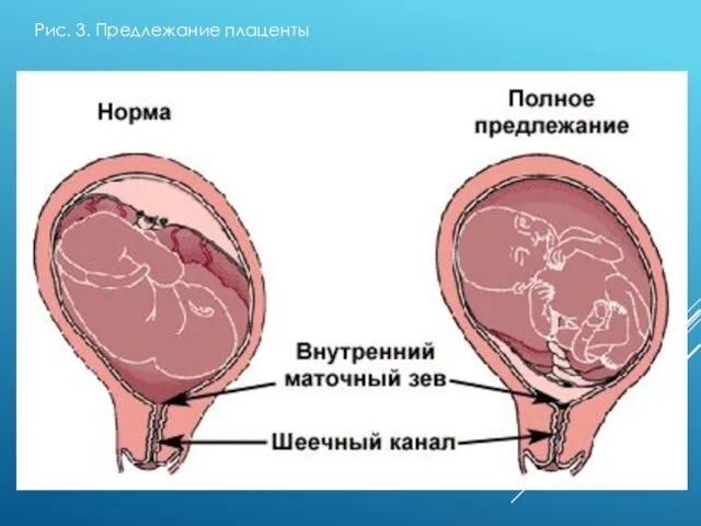 Рис. 3. Предлежание плаценты