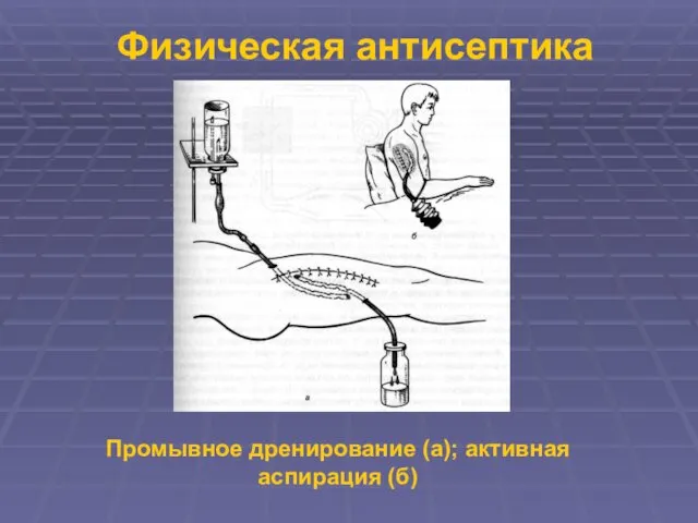 Физическая антисептика Промывное дренирование (а); активная аспирация (б)