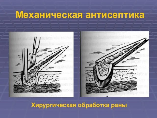 Механическая антисептика Хирургическая обработка раны