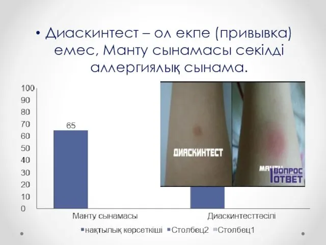 Диаскинтест – ол екпе (привывка) емес, Манту сынамасы секілді аллергиялық сынама.