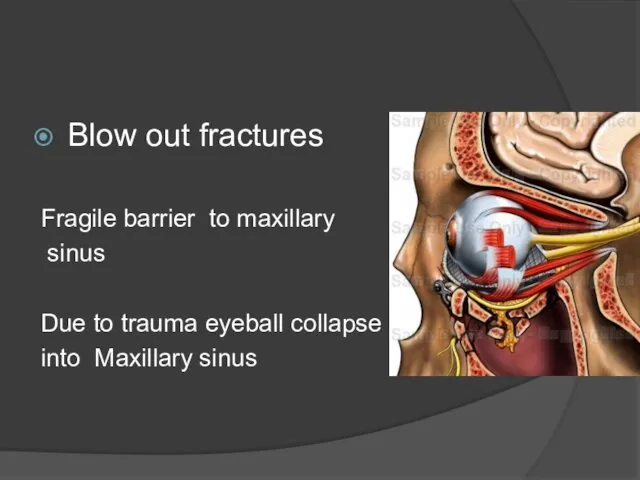Blow out fractures Fragile barrier to maxillary sinus Due to trauma eyeball collapse into Maxillary sinus