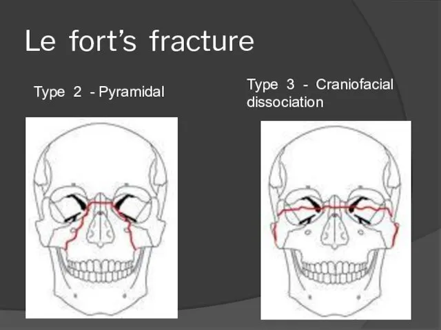 Le fort’s fracture Type 2 - Pyramidal Type 3 - Craniofacial dissociation