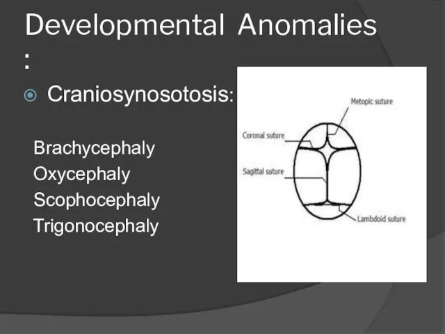 Developmental Anomalies : Craniosynosotosis: Brachycephaly Oxycephaly Scophocephaly Trigonocephaly