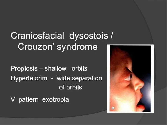 Craniosfacial dysostois / Crouzon’ syndrome Proptosis – shallow orbits Hypertelorim -