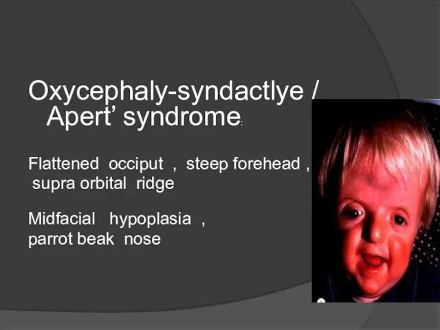 Oxycephaly-syndactlye / Apert’ syndrome: Flattened occiput , steep forehead , supra