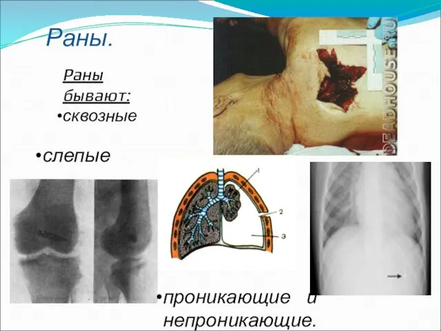 Раны. Раны бывают: сквозные слепые проникающие и непроникающие.