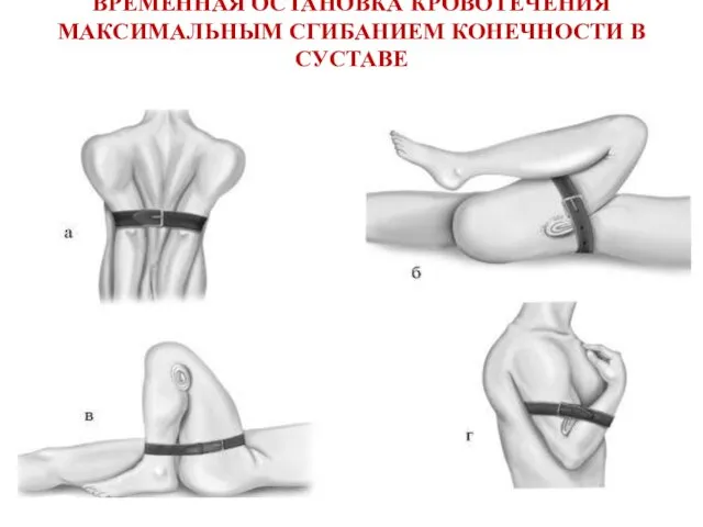 ВРЕМЕННАЯ ОСТАНОВКА КРОВОТЕЧЕНИЯ МАКСИМАЛЬНЫМ СГИБАНИЕМ КОНЕЧНОСТИ В СУСТАВЕ