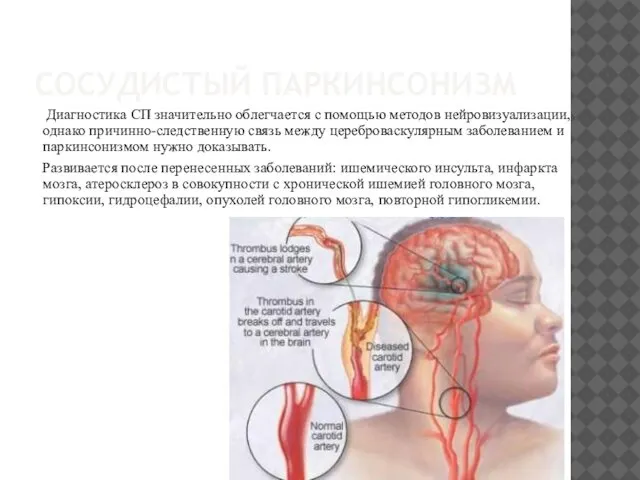 СОСУДИСТЫЙ ПАРКИНСОНИЗМ Диагностика СП значительно облегчается с помощью методов нейровизуализации, однако