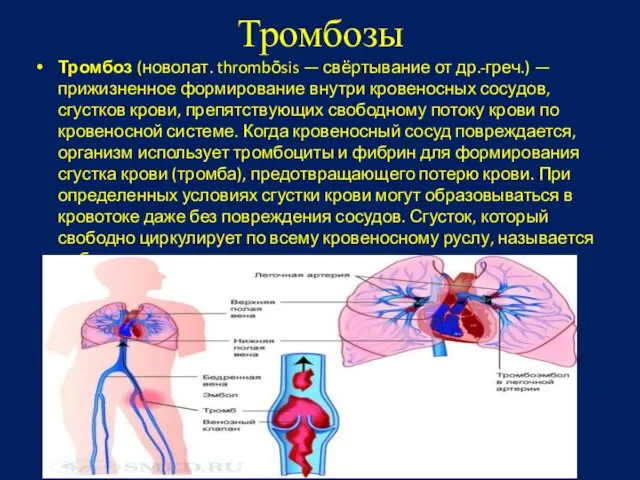 Тромбозы Тромбоз (новолат. thrombōsis — свёртывание от др.-греч.) — прижизненное формирование