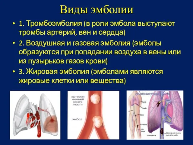 Виды эмболии 1. Тромбоэмболия (в роли эмбола выступают тромбы артерий, вен