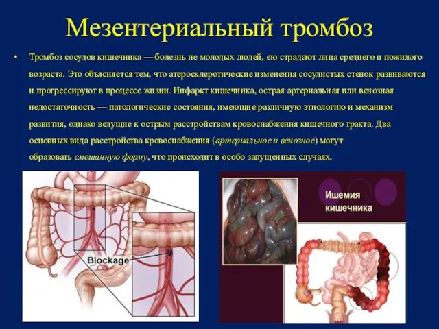 Мезентериальный тромбоз Тромбоз сосудов кишечника — болезнь не молодых людей, ею