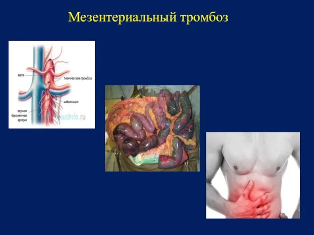 Мезентериальный тромбоз