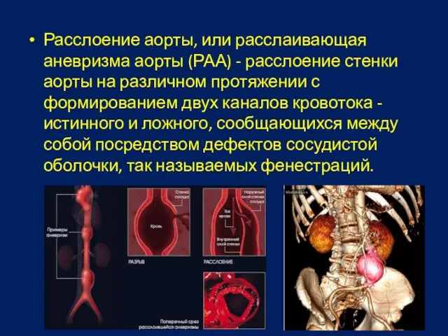 Расслоение аорты, или расслаивающая аневризма аорты (РАА) - расслоение стенки аорты