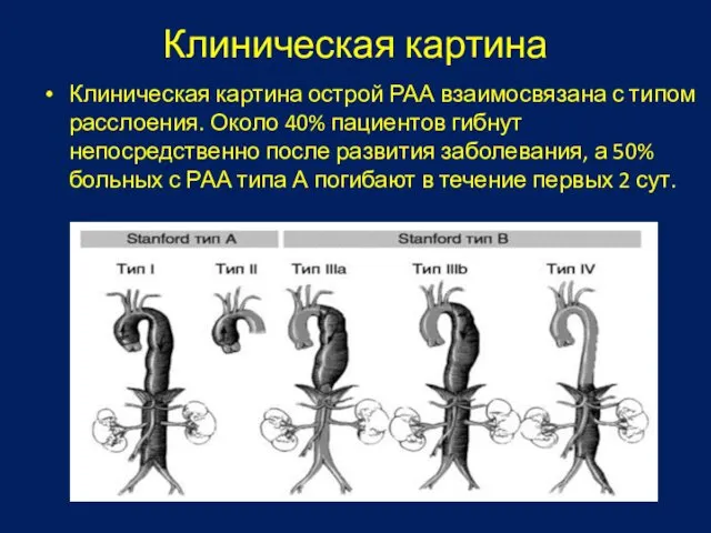 Клиническая картина Клиническая картина острой РАА взаимосвязана с типом расслоения. Около