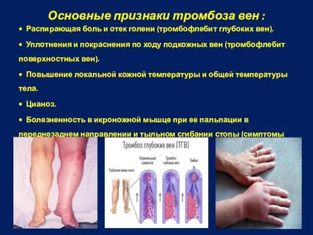Основные признаки тромбоза вен : • Распирающая боль и отек голени