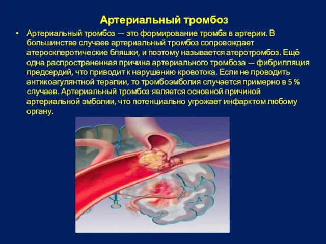 Артериальный тромбоз Артериальный тромбоз — это формирование тромба в артерии. В