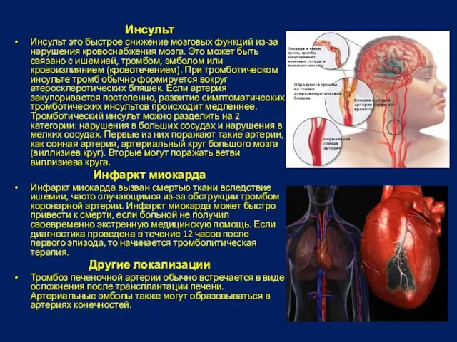 Инсульт Инсульт это быстрое снижение мозговых функций из-за нарушения кровоснабжения мозга.