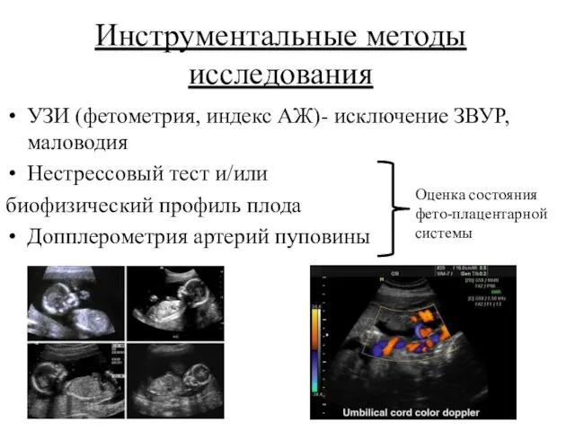 Инструментальные методы исследования УЗИ (фетометрия, индекс АЖ)- исключение ЗВУР, маловодия Нестрессовый