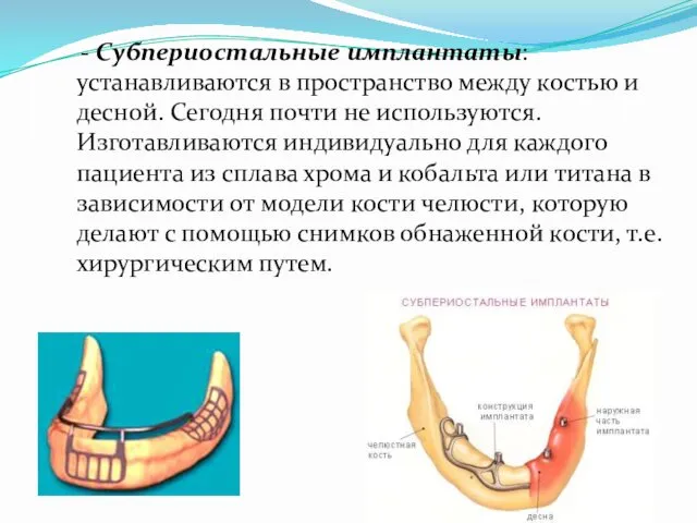 - Субпериостальные имплантаты: устанавливаются в пространство между костью и десной. Сегодня