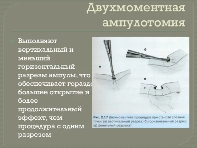 Двухмоментная ампулотомия Выполняют вертикальный и меньший горизонтальный разрезы ампулы, что обеспечивает