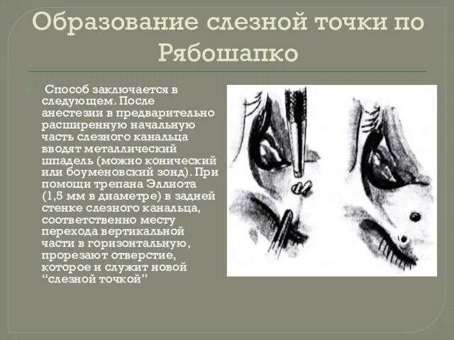 Образование слезной точки по Рябошапко Способ заключается в следующем. После анестезии