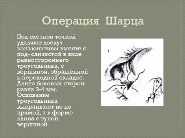 Операция Шарца Под слезной точкой удаляют лоскут конъюнктивы вместе с под-