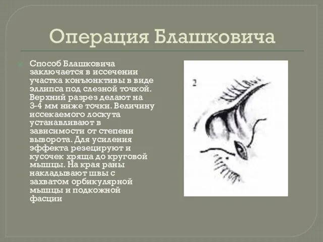 Операция Блашковича Способ Блашковича заключается в иссечении участка конъюнктивы в виде